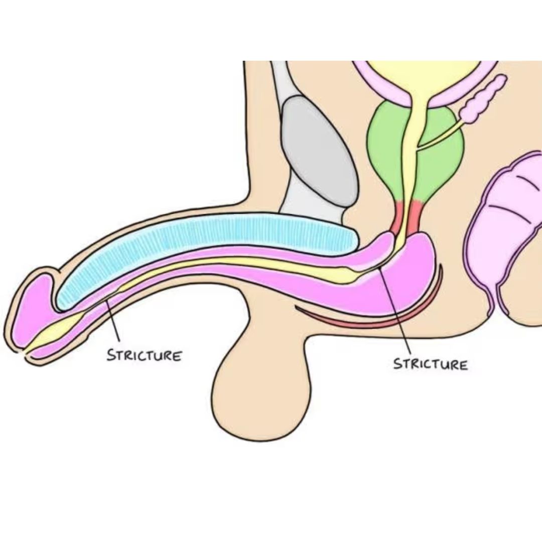 Anatomical diagram showing urethral stricture in male urinary system